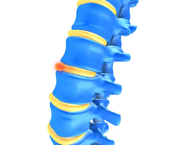 degenerative disc disease los angeles pain associates 2 - Degenerative Disc Disease