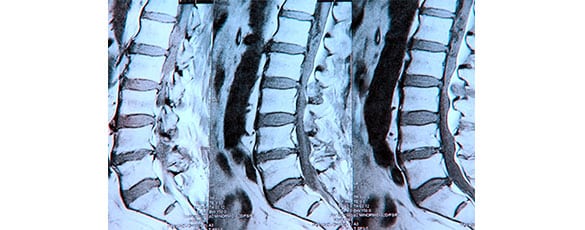 lumbar sympathetic block los angeles pain associates 3 - Lumbar Sympathetic Block