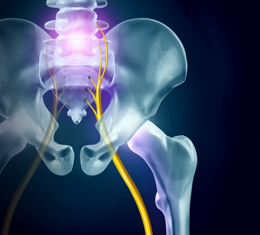 sciatica doctor in los angeles los angeles pain associates 3 - Sciatica Doctor in Los Angeles