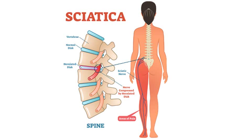 sciatica specialist in los angeles los angeles pain associates 3 - Sciatica Specialist in Los Angeles